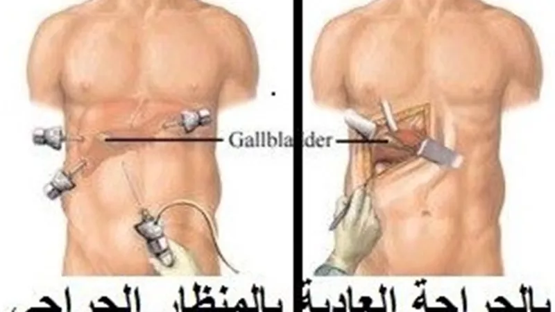 مميزات إستئصال المرارة بالمنظار