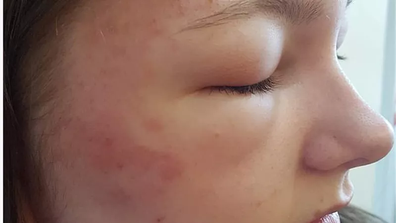 صبغة شعر تصيب فتاة بالعمى .. صور