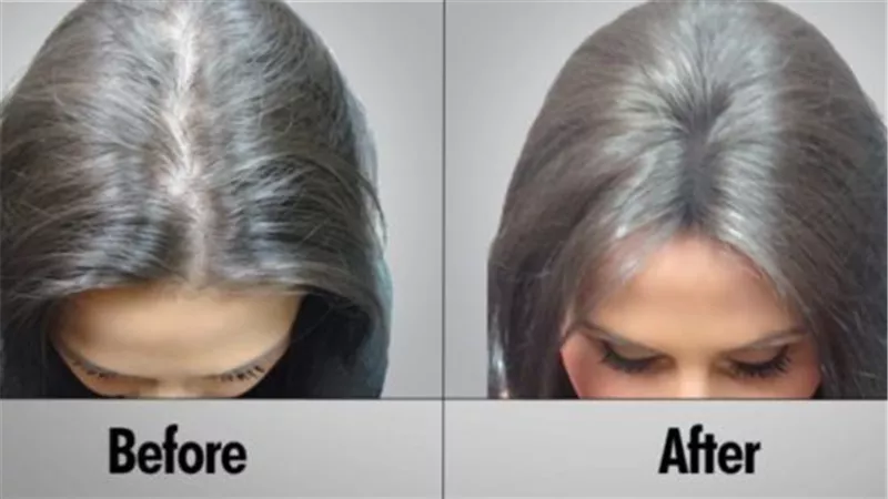 أفضل أماكن زراعة الشعر حول العالم
