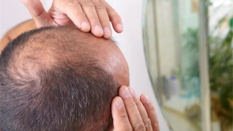 أطعمة تساعدك على التخلص من الصلع