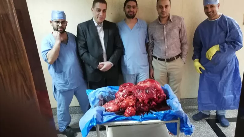 استئصال ورم 30 كيلو من بطن عجوز بأسيوط