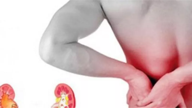 هذة المشروبات ينصح بها الأطباء لعلاج حصوات الكلى