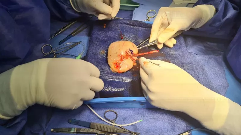 تقنية جديدة لتحليل تركيبة حصى الكلى قبل تفتيتها بالليزر