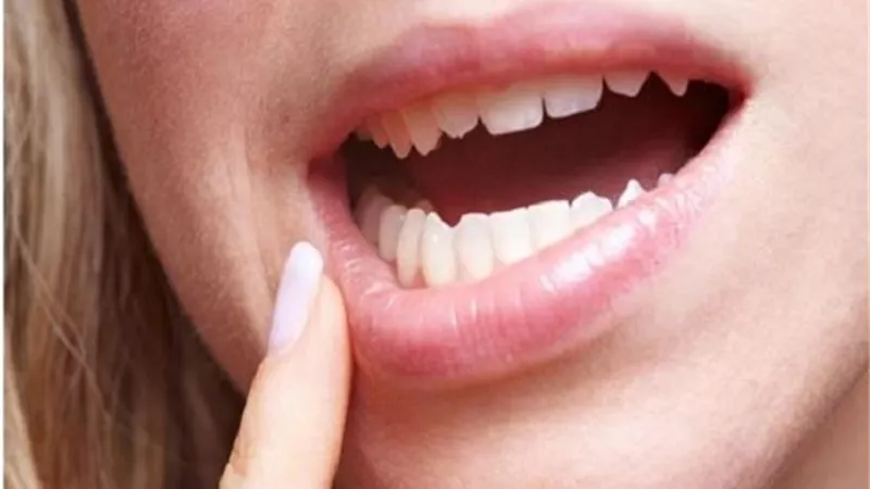 6 نصائح للتعامل مع قرح الفم