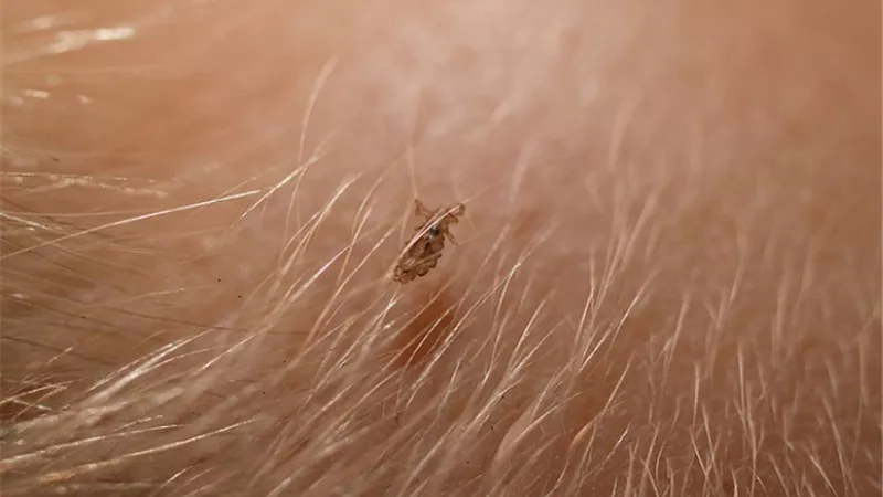 قمل الراس وخطوات العلاج..تعرف عليه