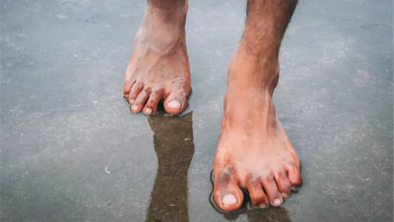 الأقدام المبللة تسبب مرض خطير .. طبيبة تحذر
