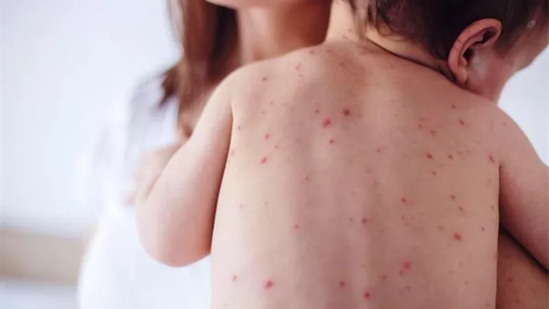 6 نصائح مهمة لحماية أسرتك من وباء الجديري المائي