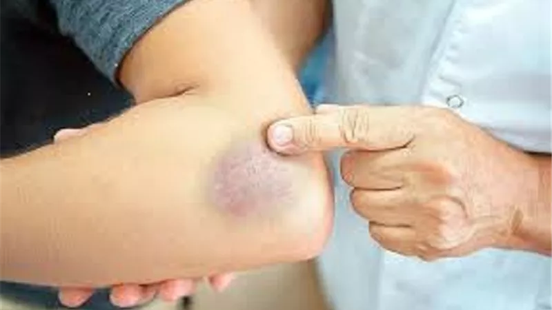 كيف تميز بين الكدمات والكسور لدى الأطفال ؟ طبيب يوضح