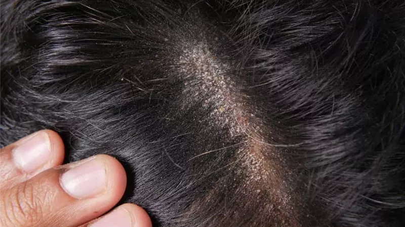 7 خطوات للتخلص من فطريات الشعر..تعرف عليها