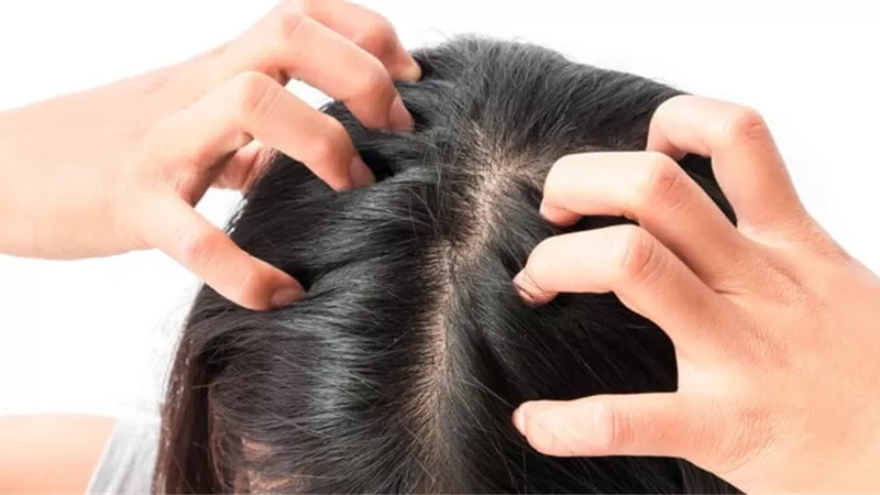 نصائح للتخلص من قشرة الرأس