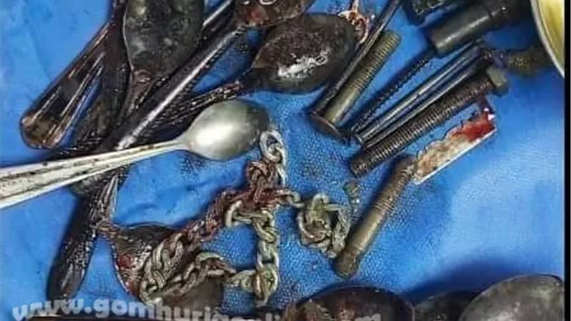 أربعيني يأكل الملاعق والمسامير..وطب جامعة المنوفية ينقذه من الموت