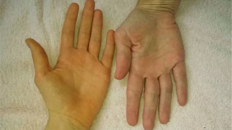 5 طرق للتخلص من مشكلة اصفرار اليدين..تعرف عليها