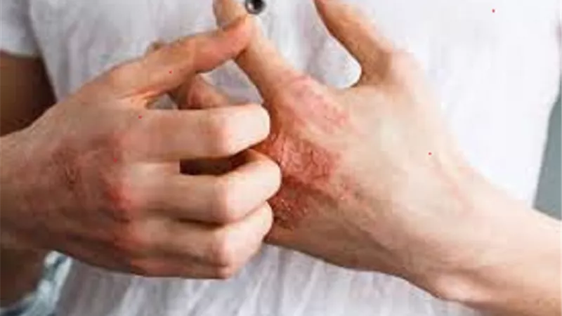 الأعراض والأسباب والعلاج .. كل ما تريد معرفته عن مرض الإكزيما