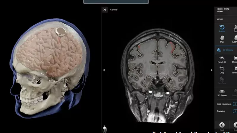 إيلون ماسك يعلن عن نجاح زرع شريحة دماغية في أول إنسان