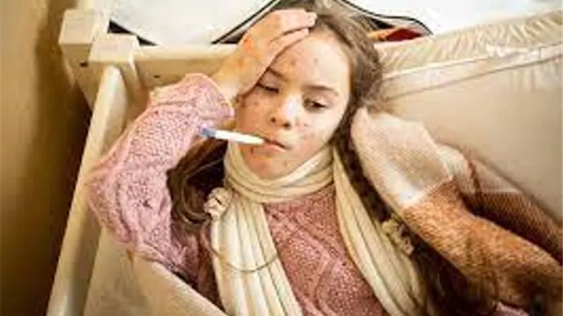 الحصبة تثير الذعر والقلق في القارة البيضاء