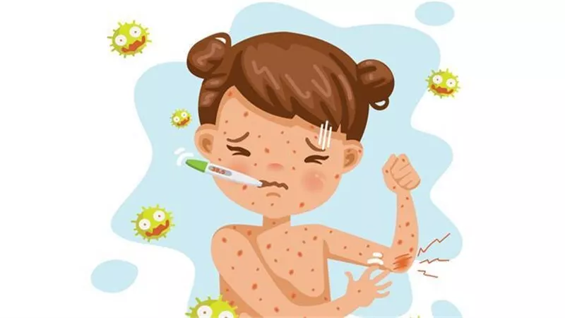 أعراض واضحة للإصابة بمرض الحصبة..لا تتجاهلها