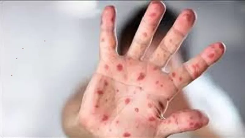 بعد وفاة أول حالة .. كل ما تريد معرفته عن جدري ألاسكا