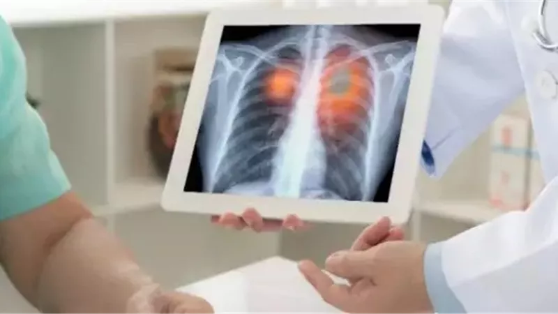 4 أعراض تدل على إصابتك بـ سرطان الرئة