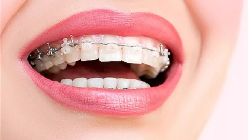 ابتكار مادة تجعل تكاليف عملية تقويم الأسنان أرخص وأسرع