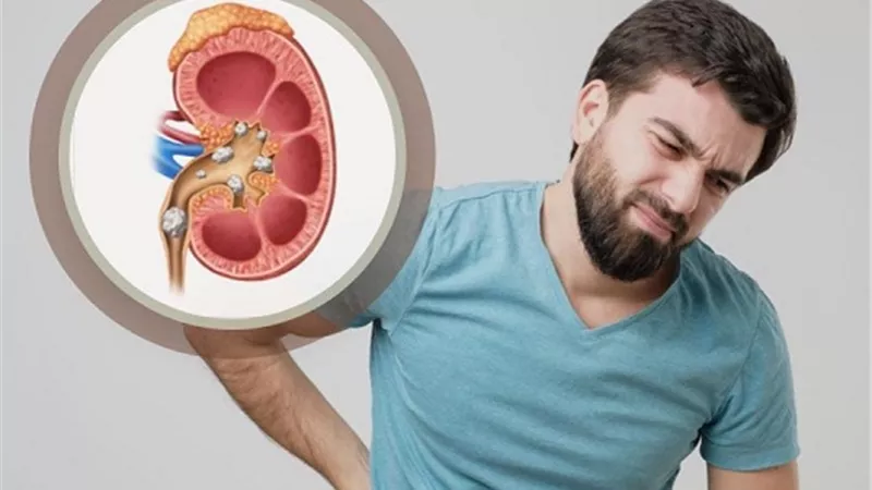 5 علامات تنذرك بالإصابة بحصوات الكلى