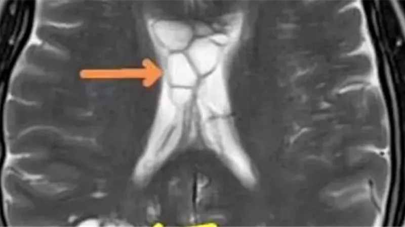 دودة شريطية تضع بيضها في دماغ رجل .. وهذا ما حدث له