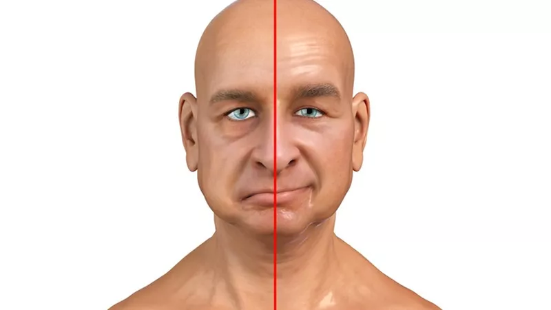 اسباب واعراض شلل الوجه..تعرف عليها