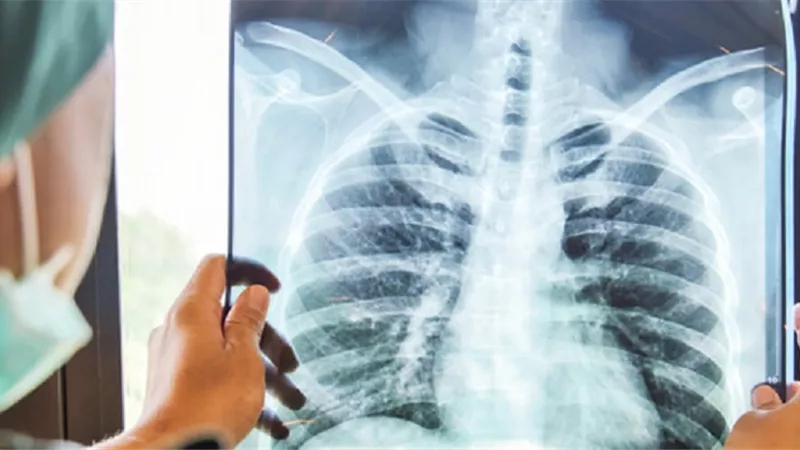 دراسة جديدة... السل يزيد خطر الإصابة بأنواع مختلفة من السرطان