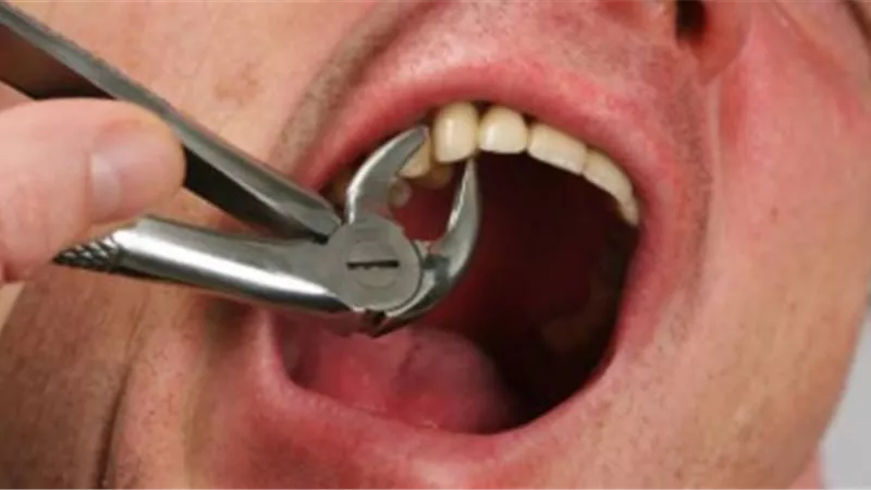 حكمُ خلعِ الأسنانِ أثناء الصيام