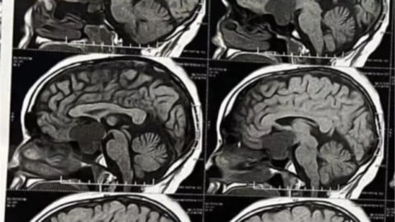 عودة الرؤية لشاب عشريني بعد استئصال ورم بالجمجمة بسوهاج