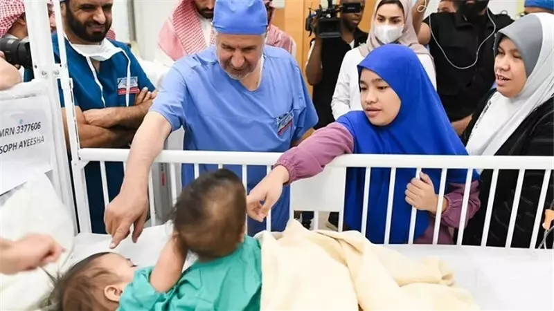 بدء عملية فصل التوأم السيامي 