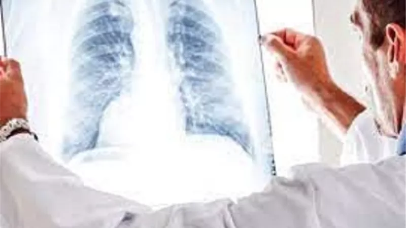 علاجات متطورة لسرطان الرئة تعطي الأمل للمرضى