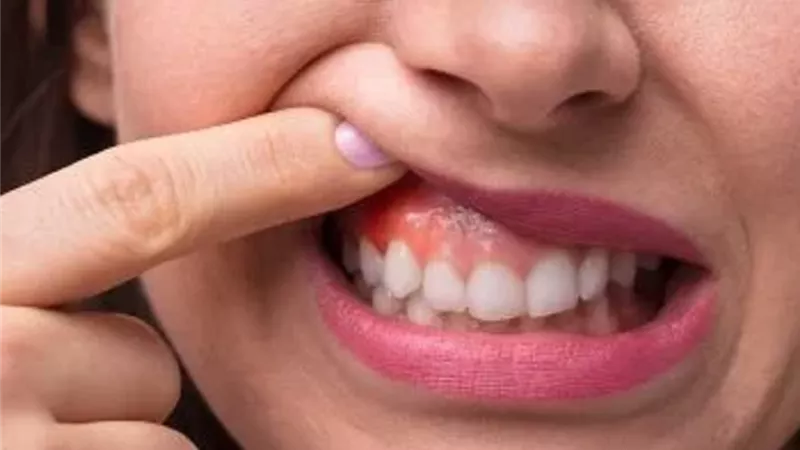 أعراض غير متوقعة تكشف سرطان الفم