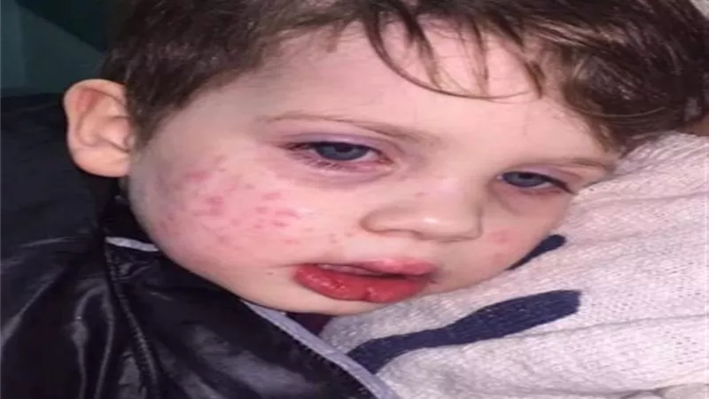 قبلة تصيب طفل بمرض جلدي خطير