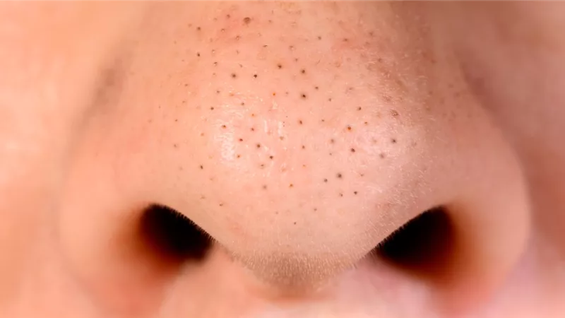 طرق التخلص من الرؤوس السوداء