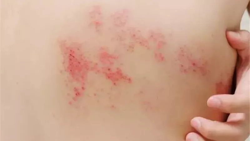 علاج الحزام الناري