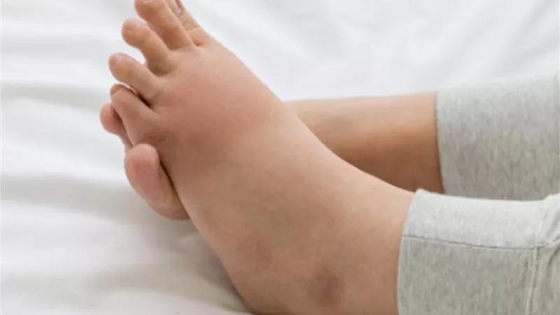 أسباب الإصابة بتورم الكاحلين