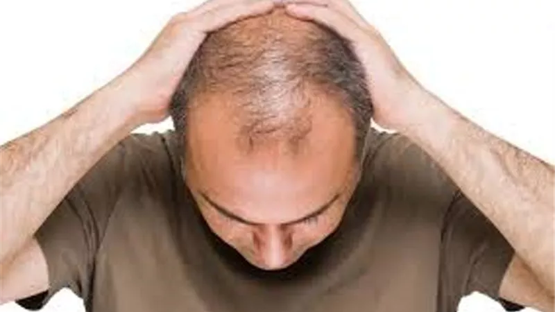باستخدام السكر..علاج جديد للصلع وتساقط الشعر