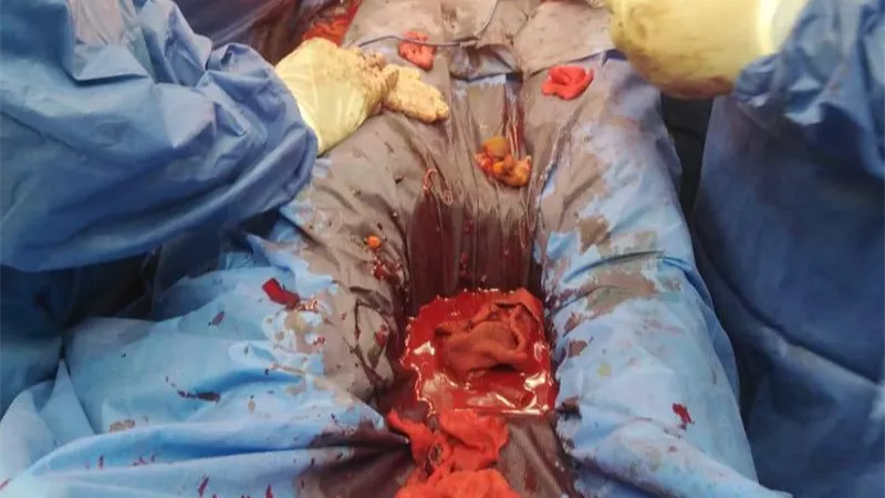 مستشفى برج البرلس تنقذ شاب بعمر الـ 28 بعد خروج امعائه