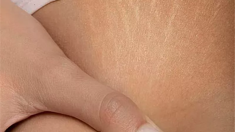 وصفات طبيعية للتخلص من علامات التمدد