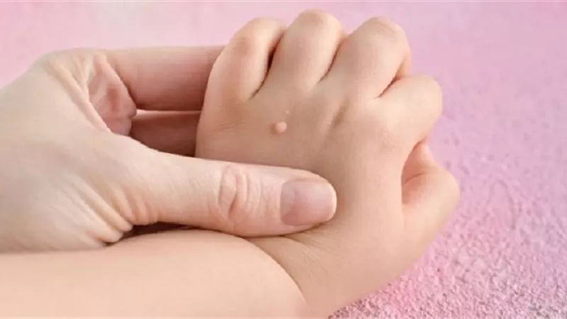طبيبة تحذر من خطر الثآليل الفيروسية عند الأطفال