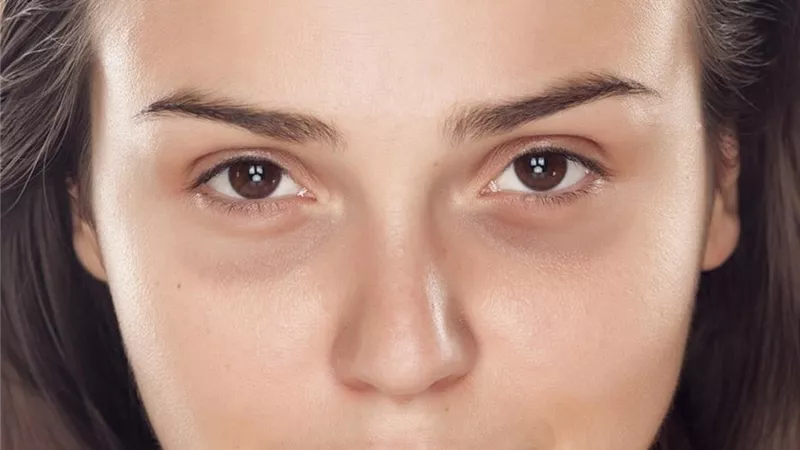 5 أسباب للهالات السوداء