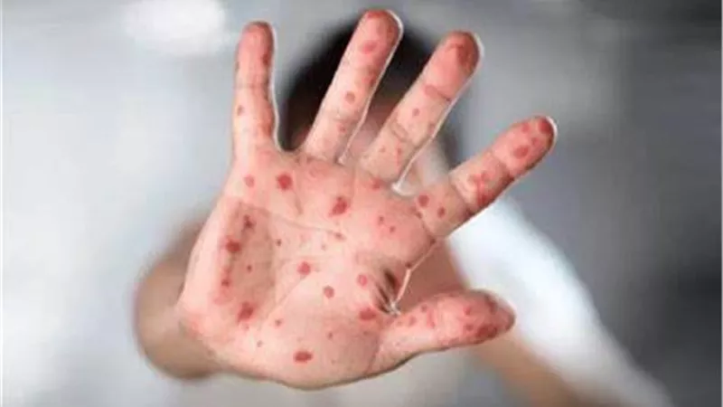 تسجيل 330 حالة إصابة بجدري القرود في منطقة جوما بالكونغو الديمقراطية