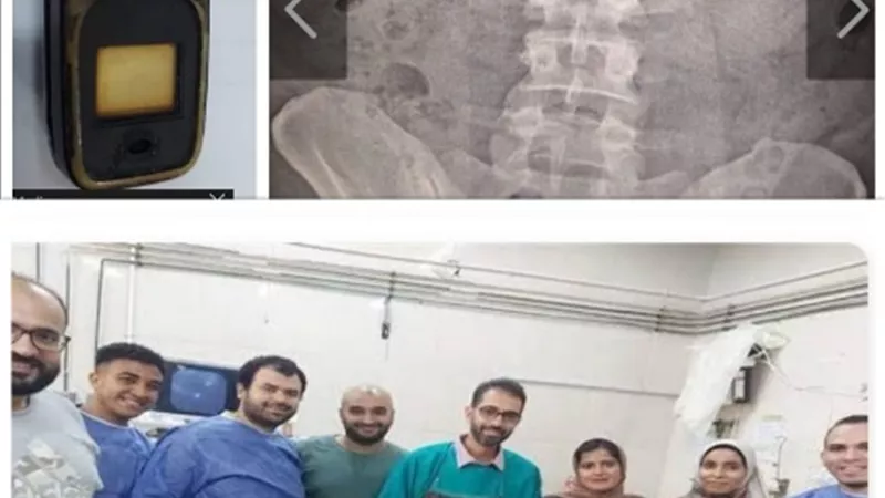استخراج تليفون من أمعاء شخص داخل مستشفى طنطا الجامعى