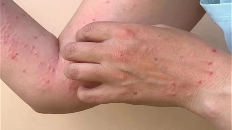 مريض بجدري القردة يكشف عن أعراض مؤلمة عانى منها