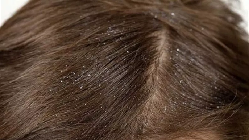 طرق علاج مشكلة قمل الرأس