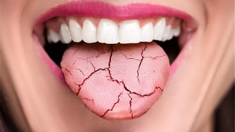 نصائح لعلاج جفاف الفم ..أبرزها تجنب الكافيين