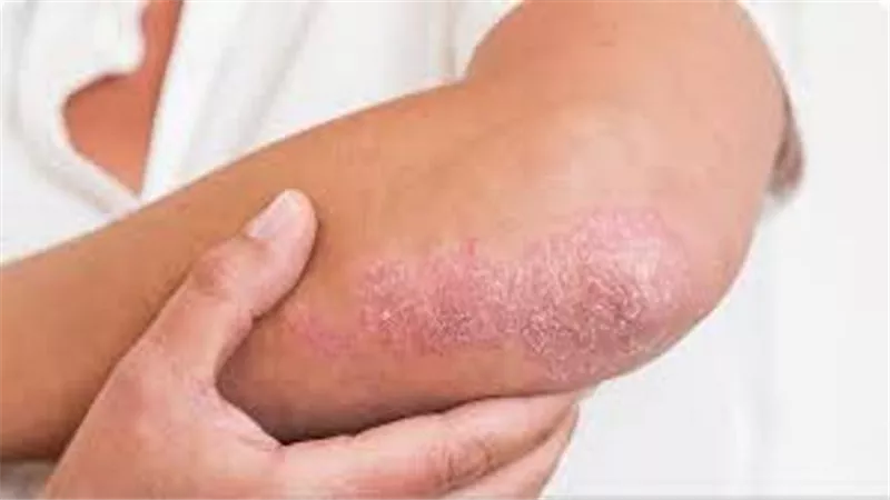 هل أعراض مرض الصدفية تختلف من شخص لآخر؟ طبيب جلدية يجيب
