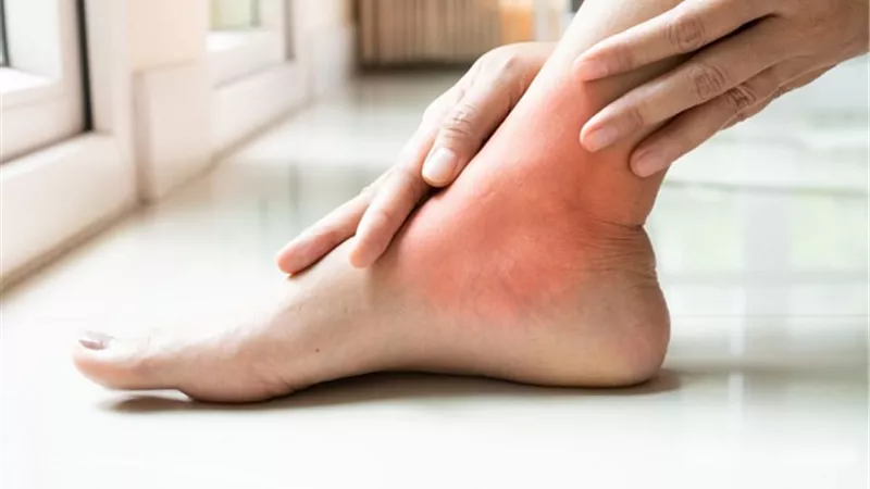 أسباب وأعراض وعلاج النقرس