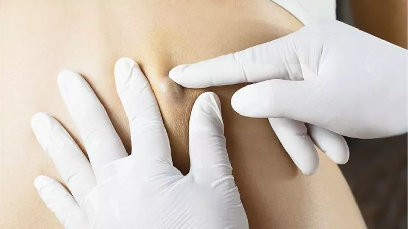 متى تشكل الأكياس الدهنية خطورة على اجسامنا؟