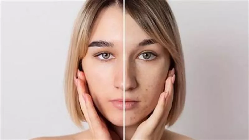 5 طرق طبية ومنزلية لعلاج تمزق الشعيرات الدموية بالوجه